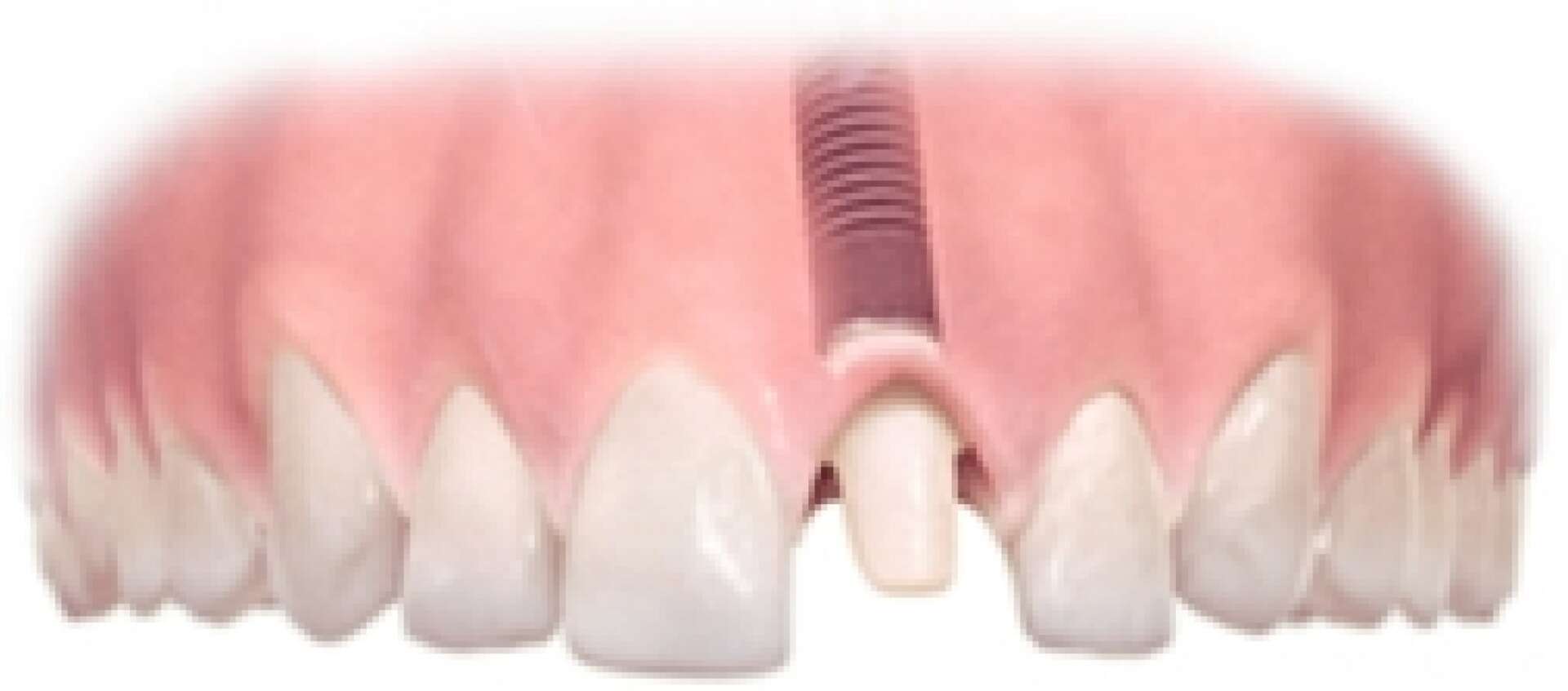 Single Tooth Implant Step 3