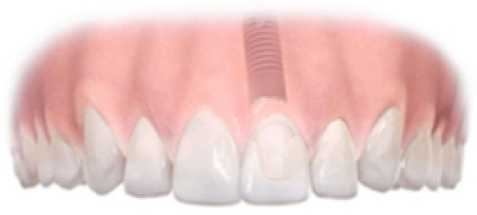 Single Tooth Implant Step 4