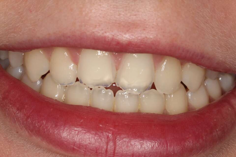 teeth with severe tooth wear