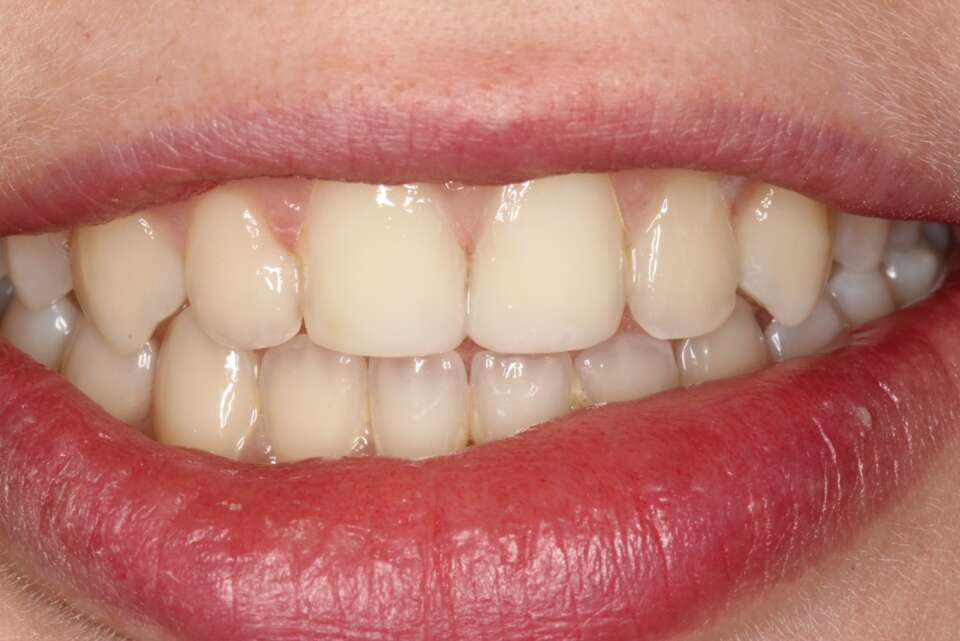 teeth restored after cosmetic bonding