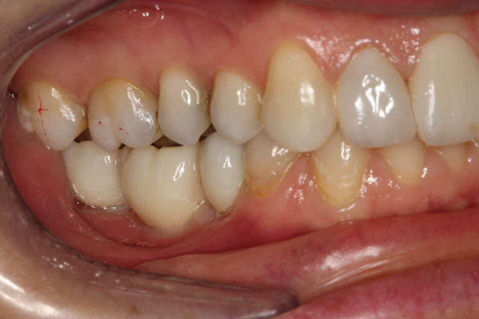 2 new dental implants in mouth