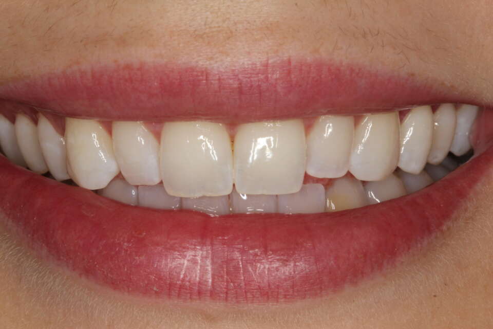 woman's smile and teeth before composite bonding treatment