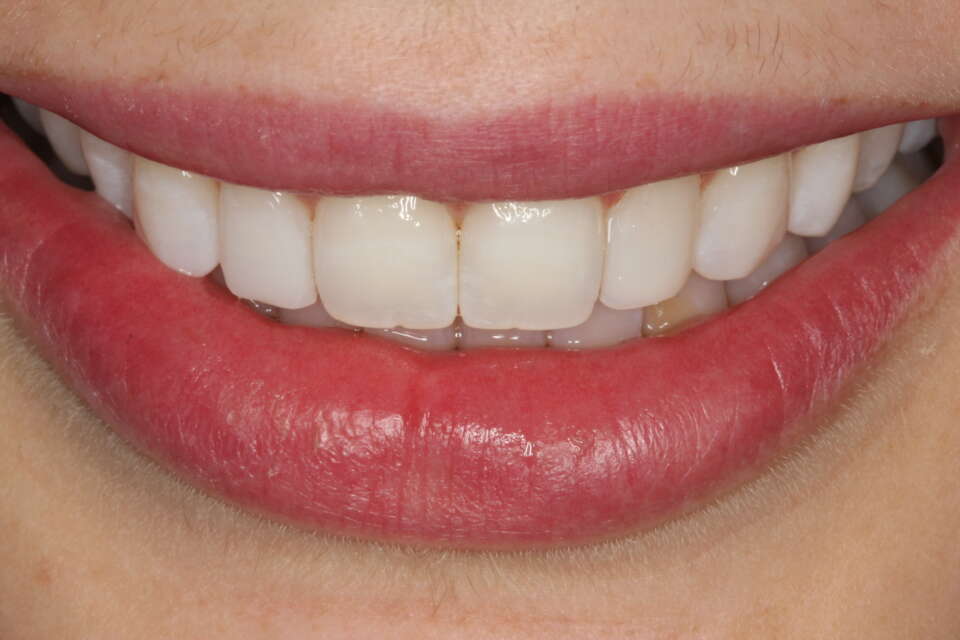 woman's smile and teeth after composite bonding treatment