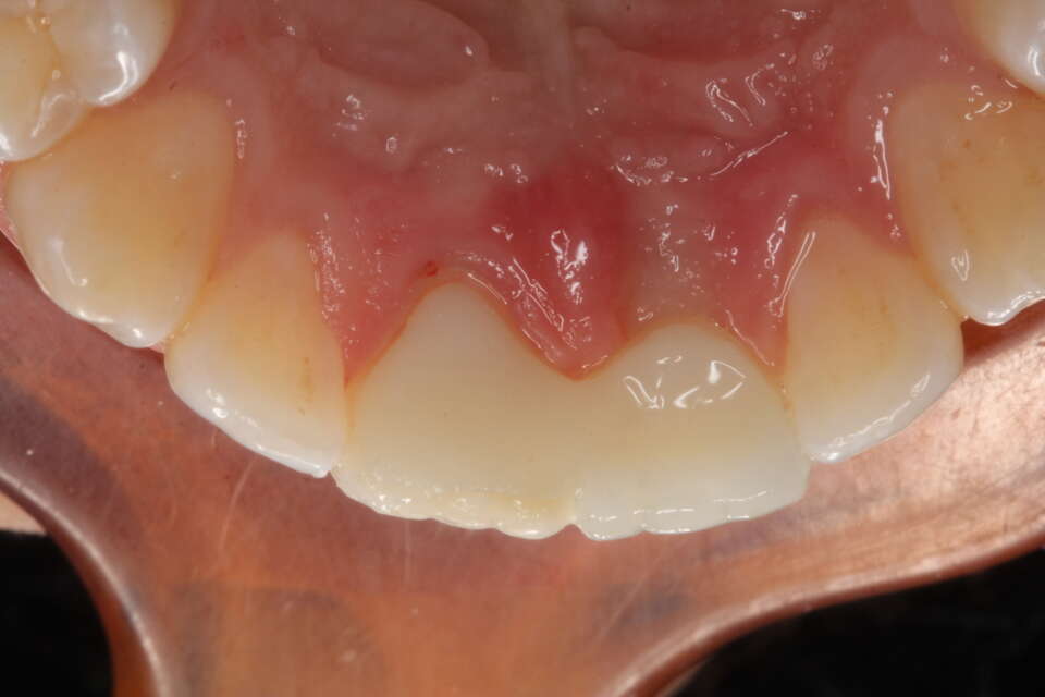 Adhesive Bridge Palatal view