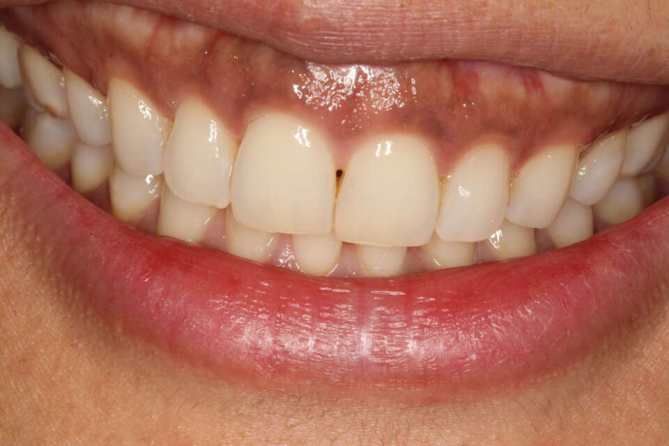 classic gingival pigmentation with a high lip line