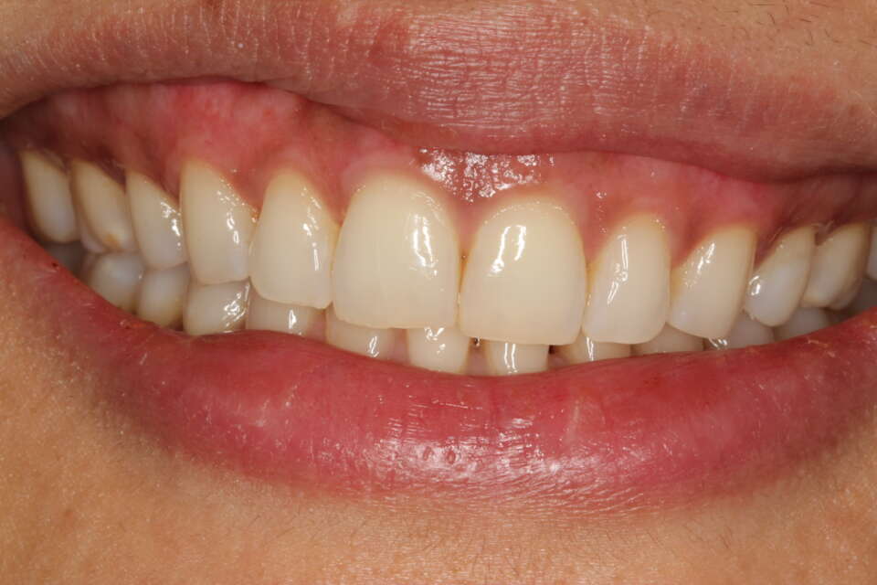 a much improved gingival profile after laser treatment