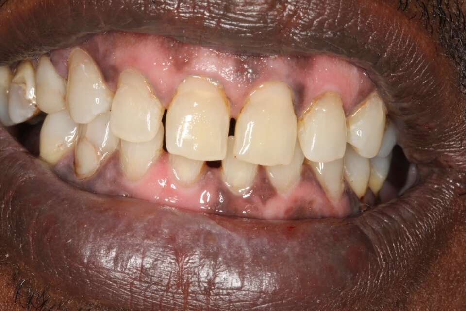 much whiter, brighter teeth after treatment