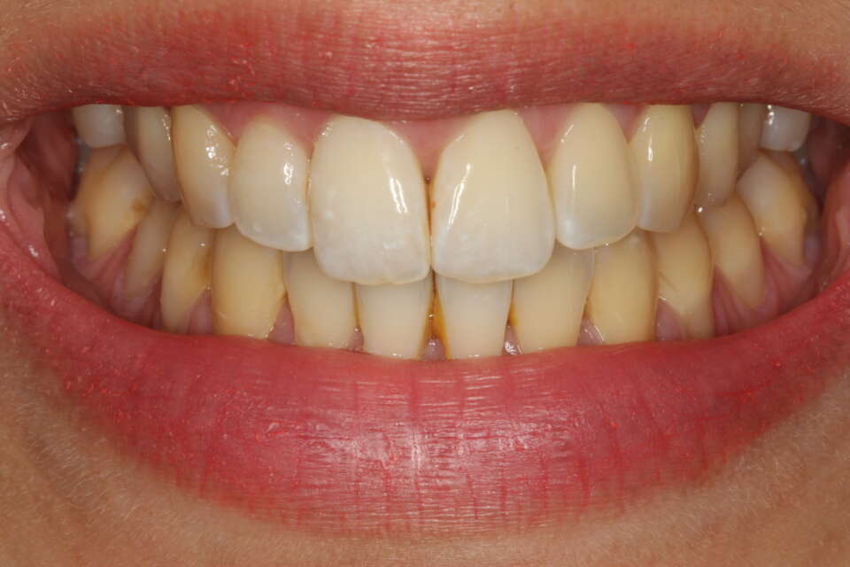 Invisalign expansion before