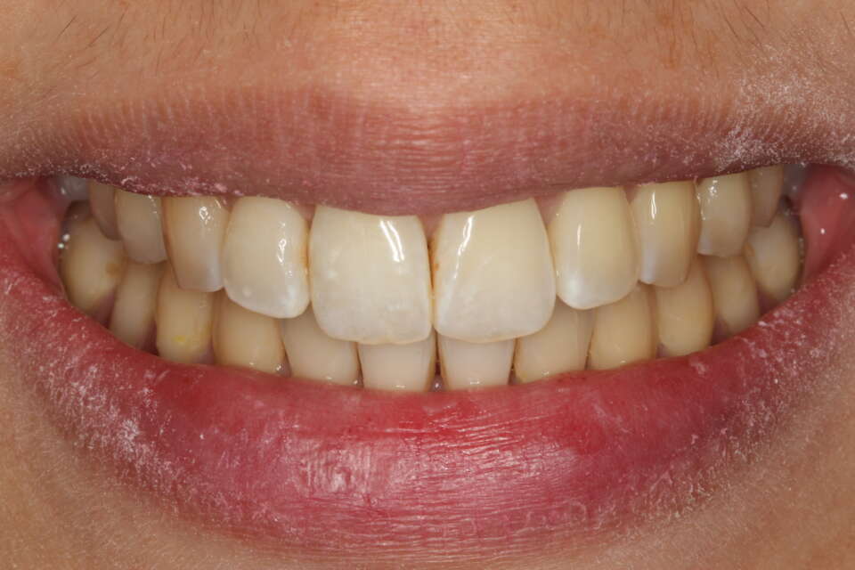 Invisalign expansion after