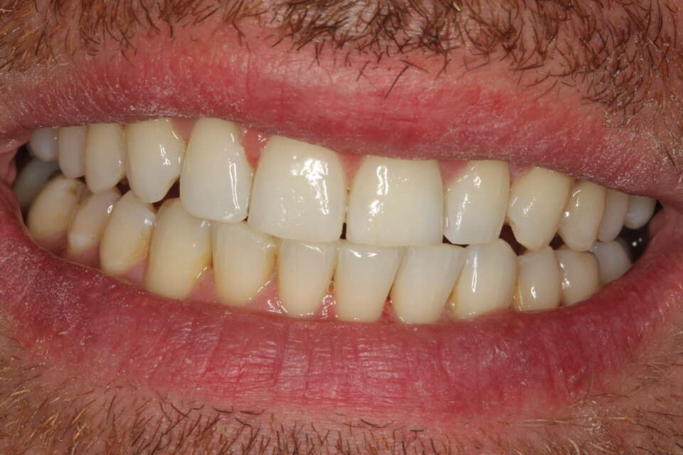 wide smile after invisalign comprehensive treatment