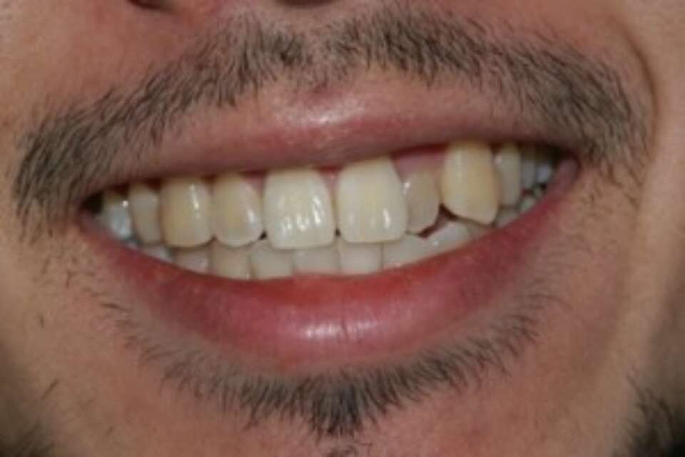 hidden tooth