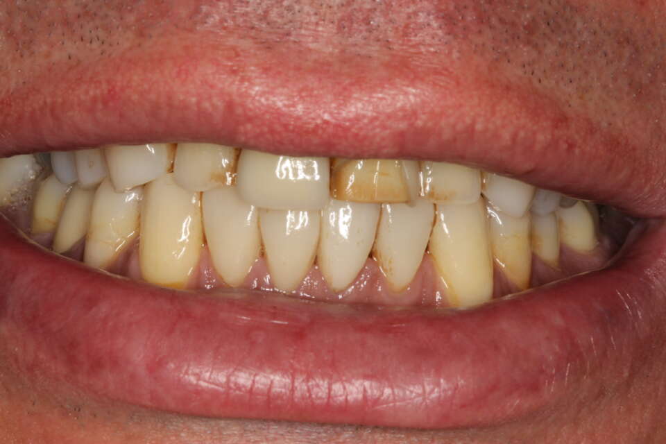 Before treatment - replace failing veneers & place veneers on adjacent teeth for symmetry