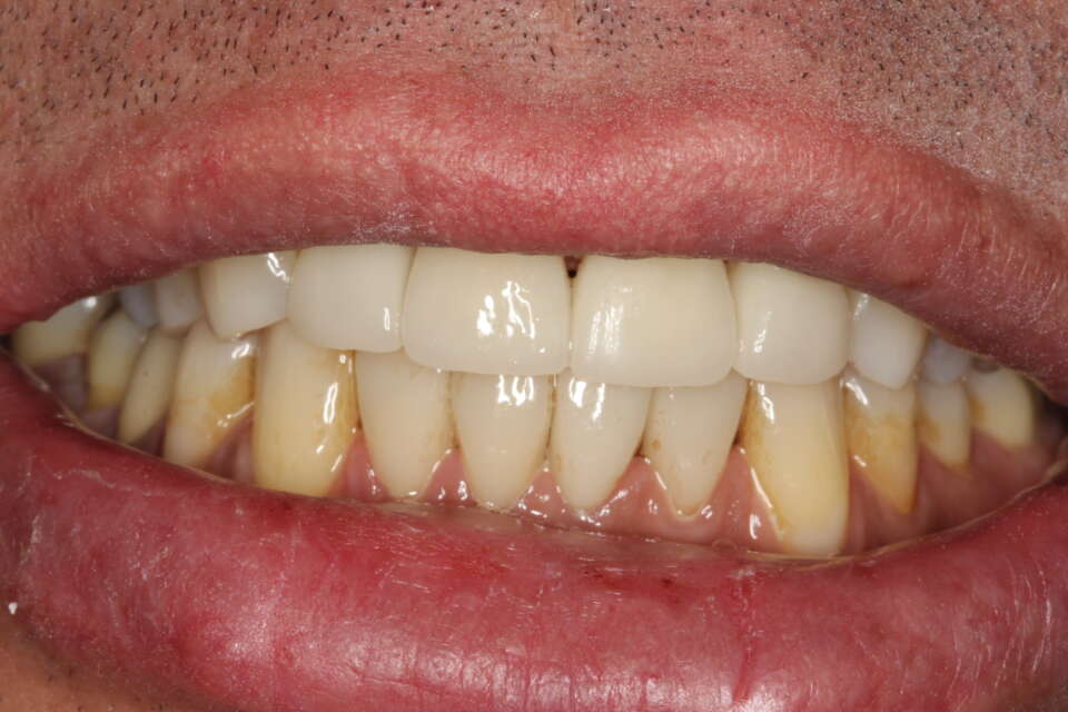 After treatment - great improvement with an even, natural, fuller smile