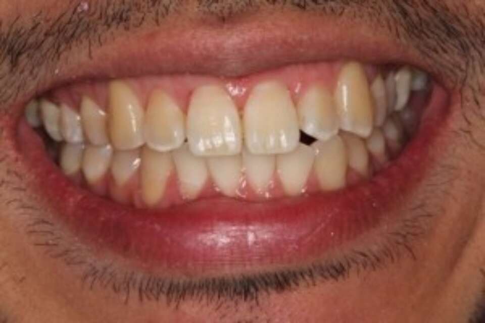 tooth back into alignment