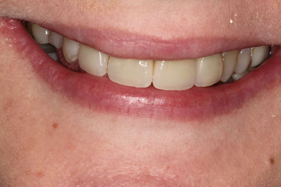 natural, aesthetic & long lasting teeth using e max veneers