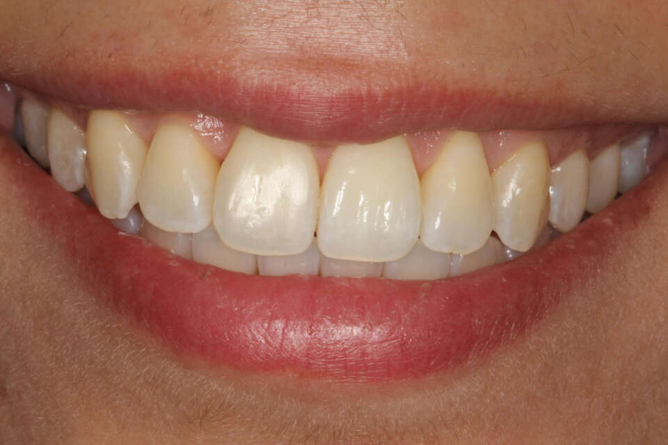 straight teeth after invisalign for rotated teeth