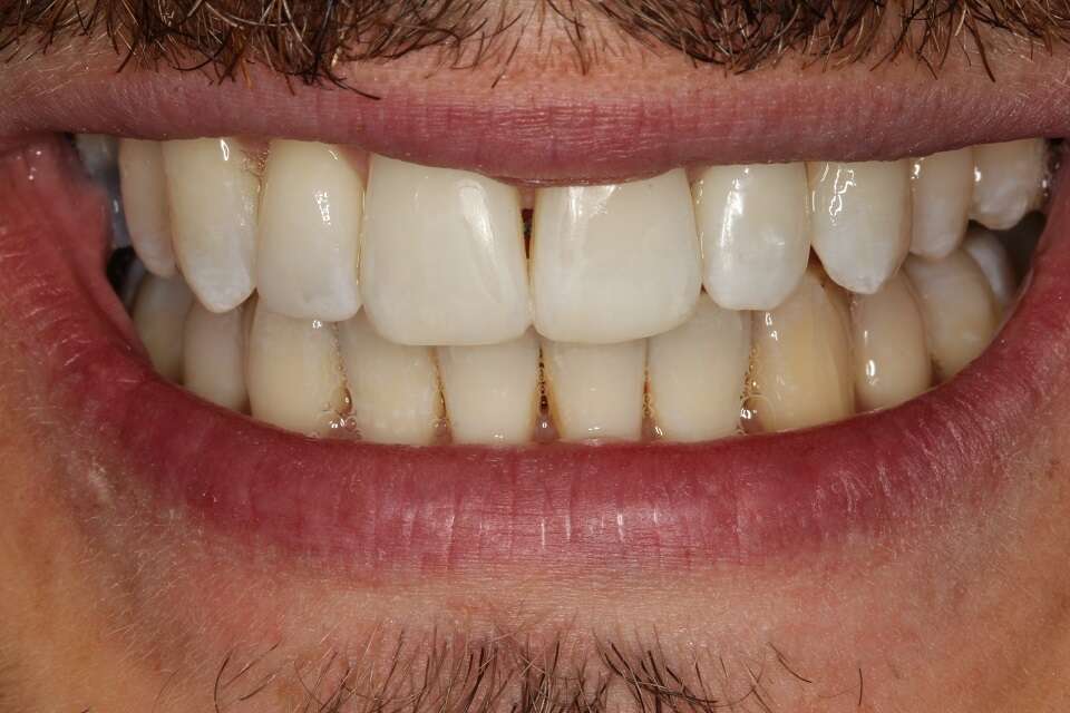 After Invisalign