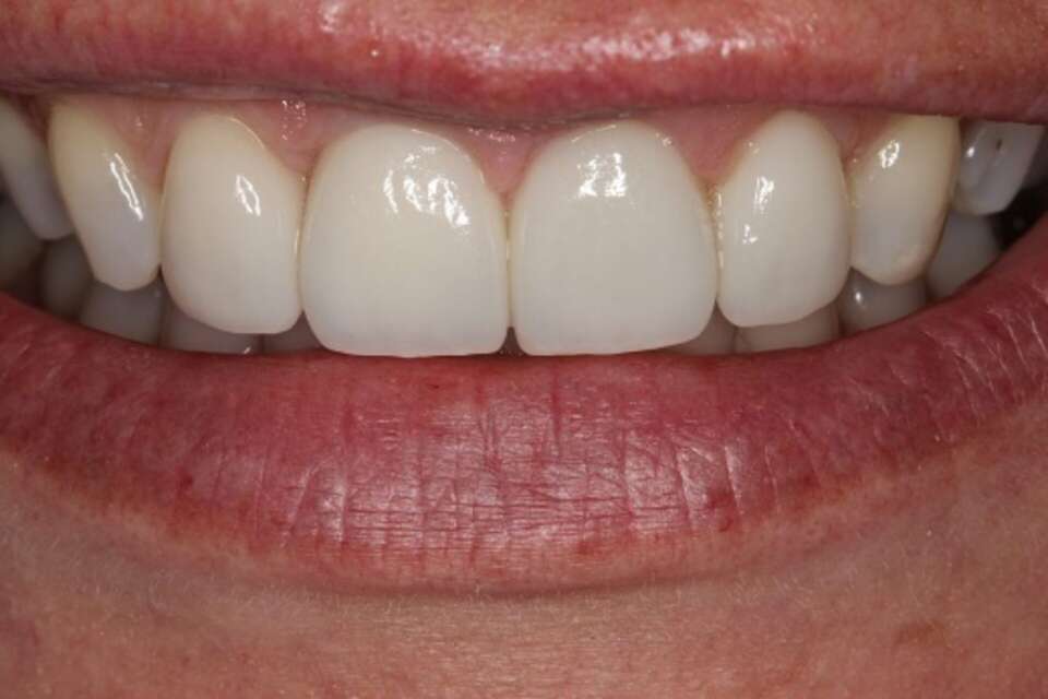 after porcelain veneers