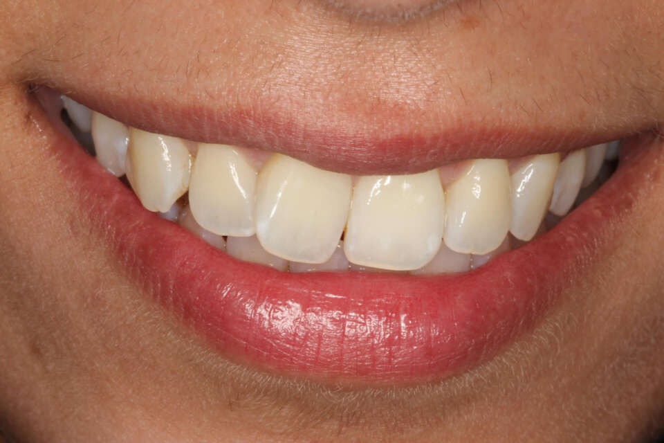 right central incisor rotated outwards before invisalign for rotated teeth
