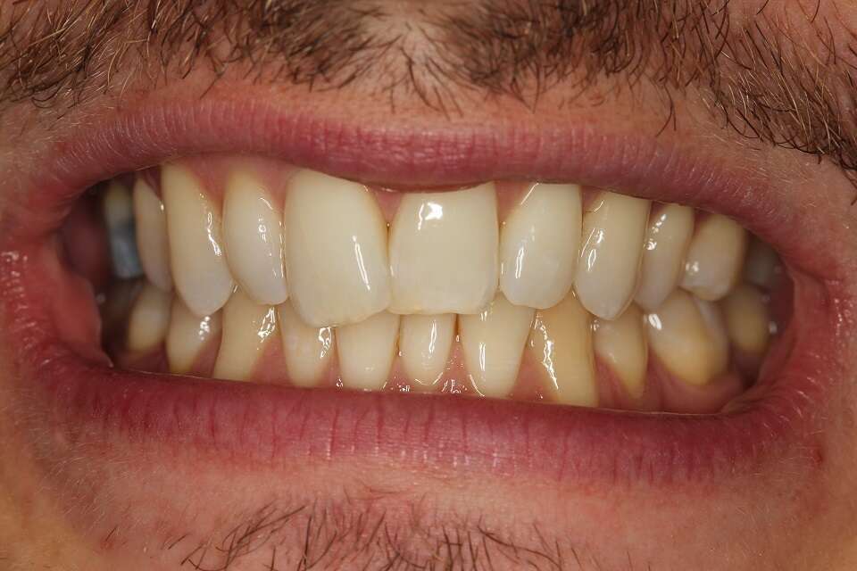 crowding of upper & lower teeth, uneven edges, yellow shade