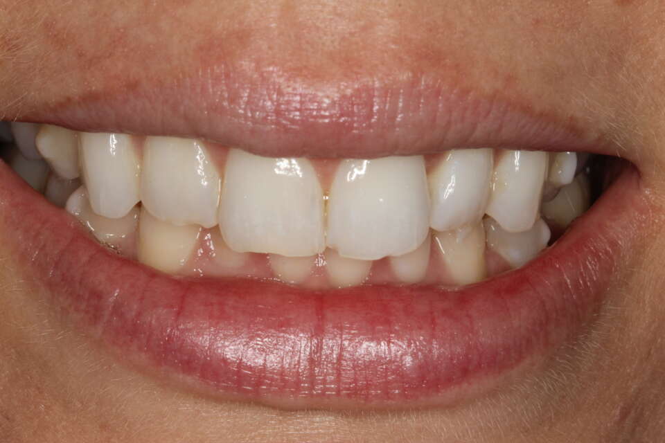 Before cosmetic bonding of the front 4 teeth uneven and chipped teeth