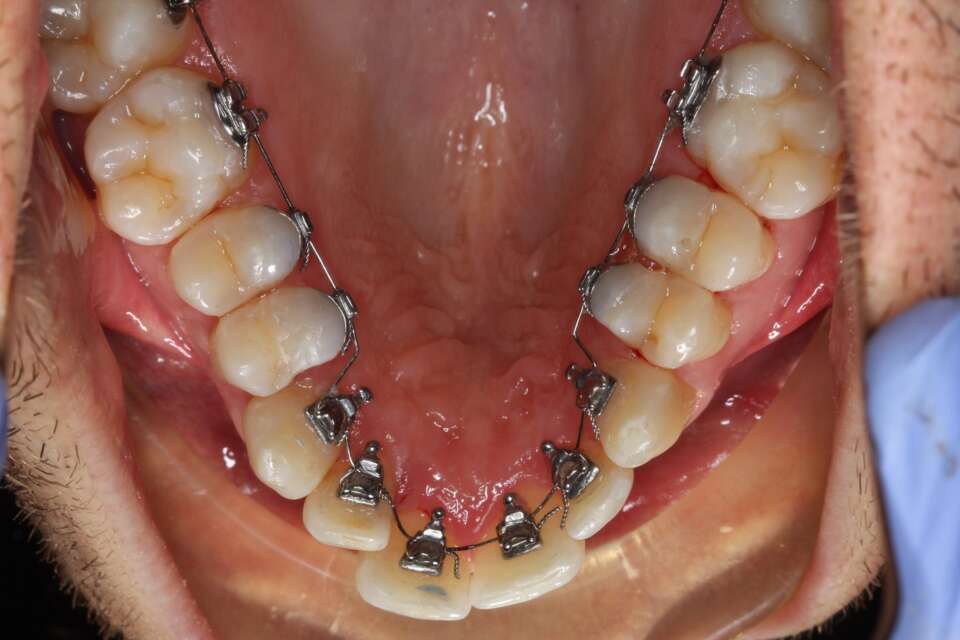 Full arch lingual braces