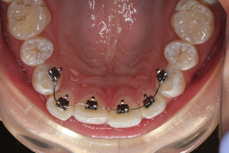 Social 6 lingual braces