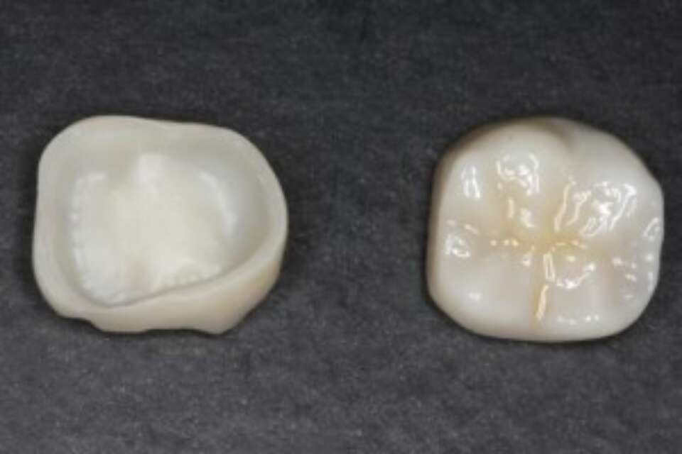 zirconia crowns