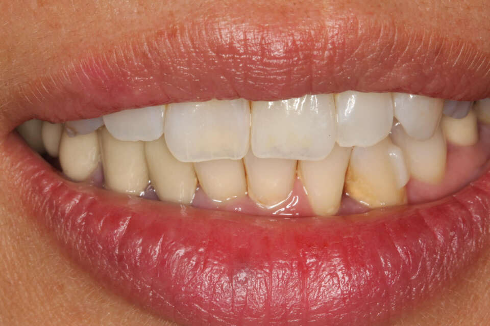 After invisalign and crown