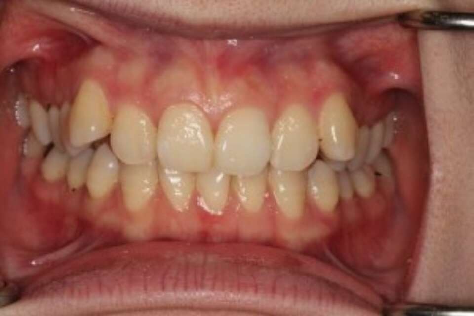 before ceramic orthodontic treatment