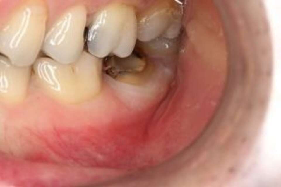 broken down back tooth