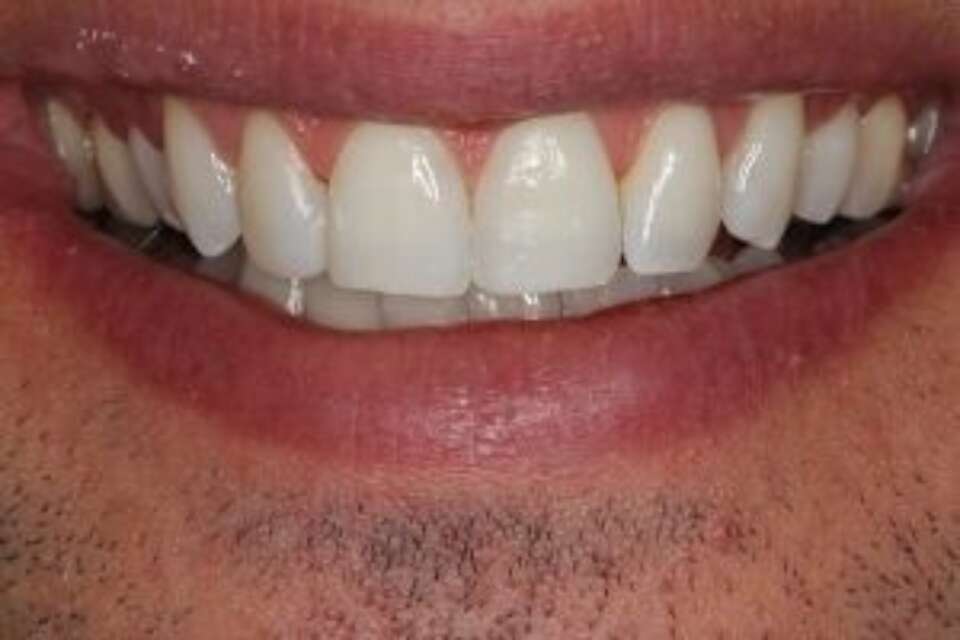 Composite veneers on front 4 teeth