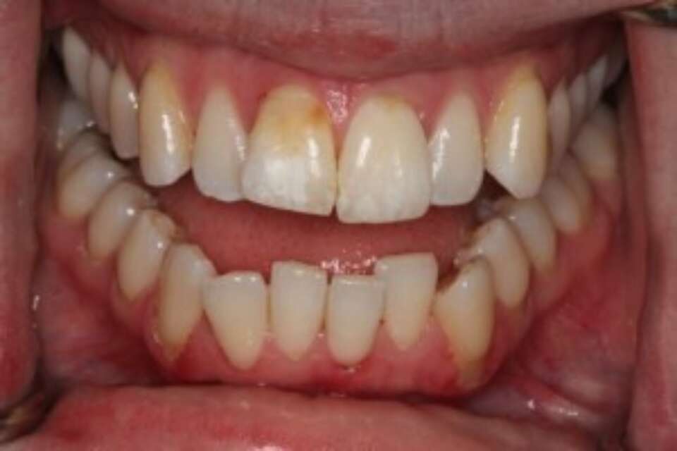Crooked upper lower teeth