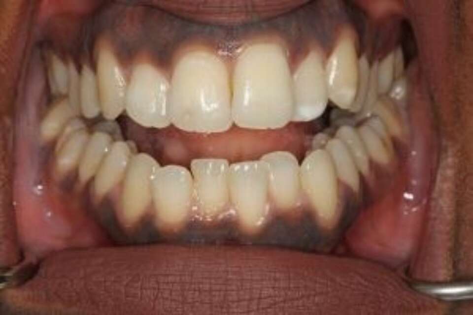 crowded lower front teeth