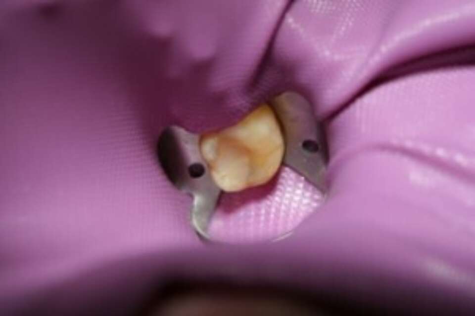 dental dam