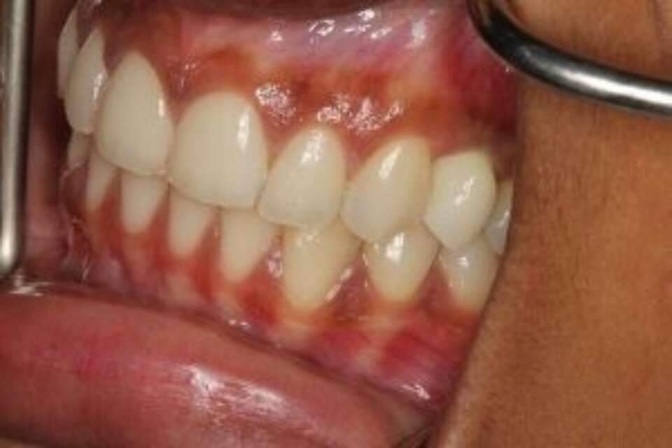 Dental implant crown