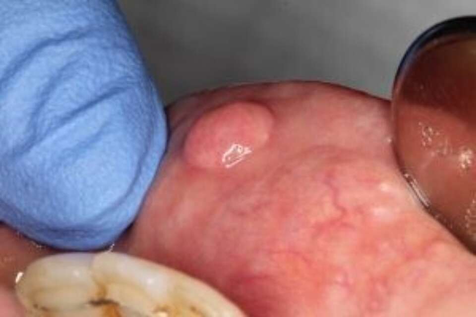 fibroepithelial polyp inside lower lip