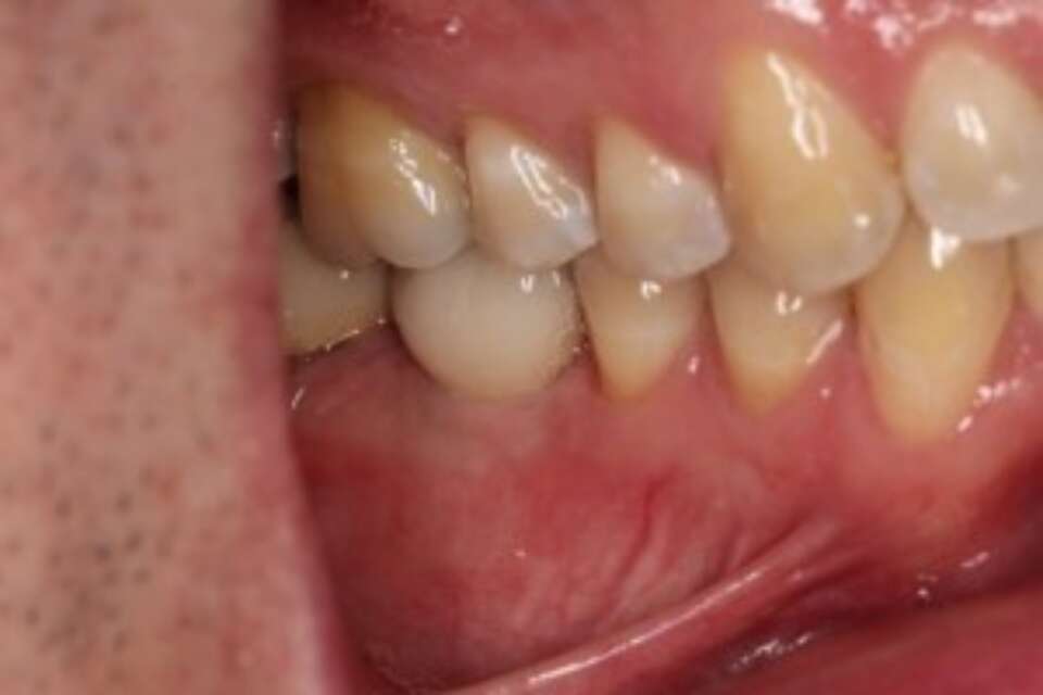 Fully restored dental implant