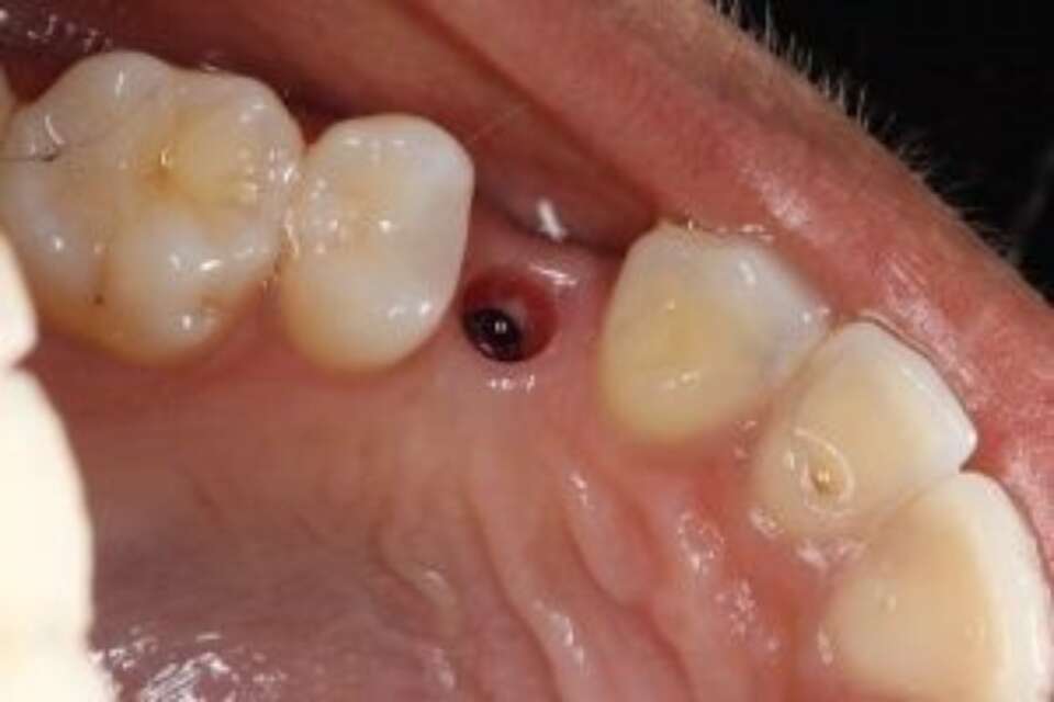 Healed dental implant