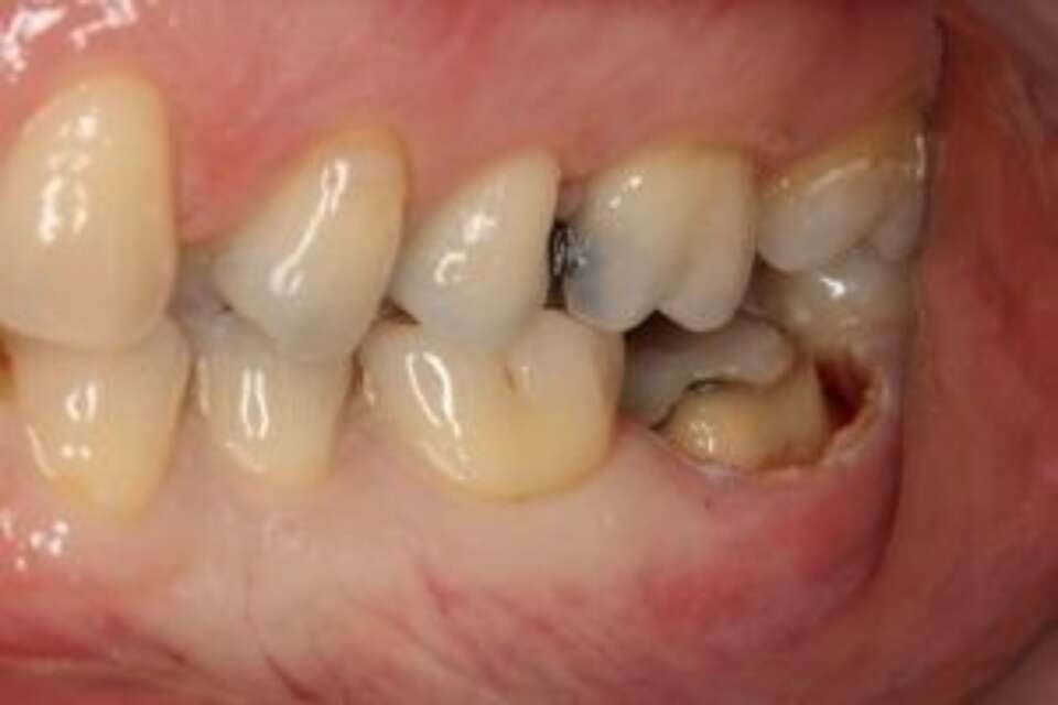 lengthen tooth with waterlase iplus laser treatment