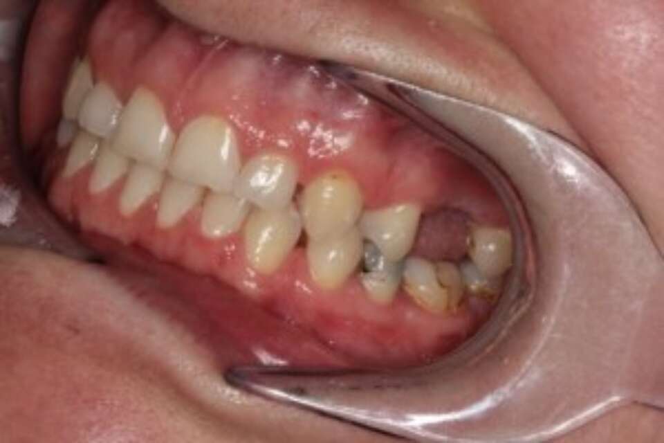 Missing molar