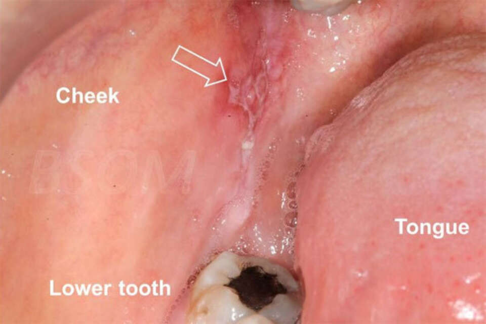 Mouth cancer