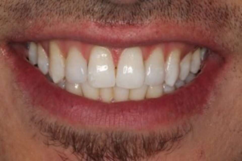 No spaces between front teeth