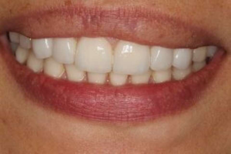 Porcelain veneers on front 6 teeth
