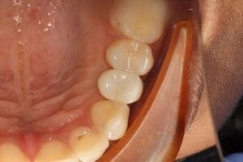 Screw retained occlusal view