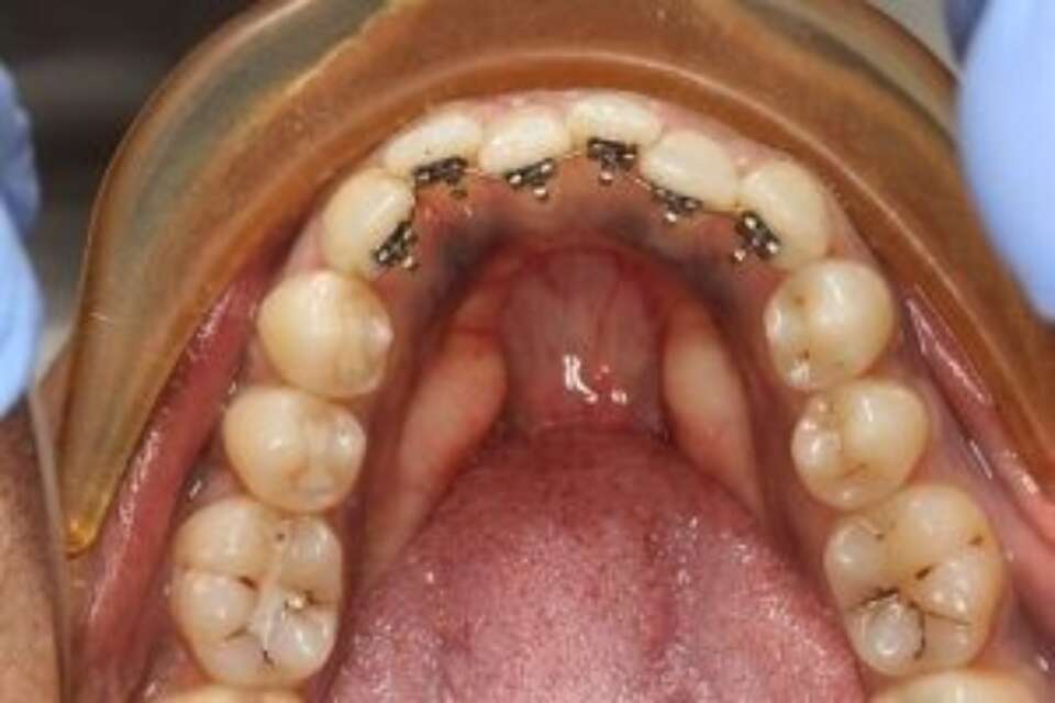 social six teeth 2 d brackets