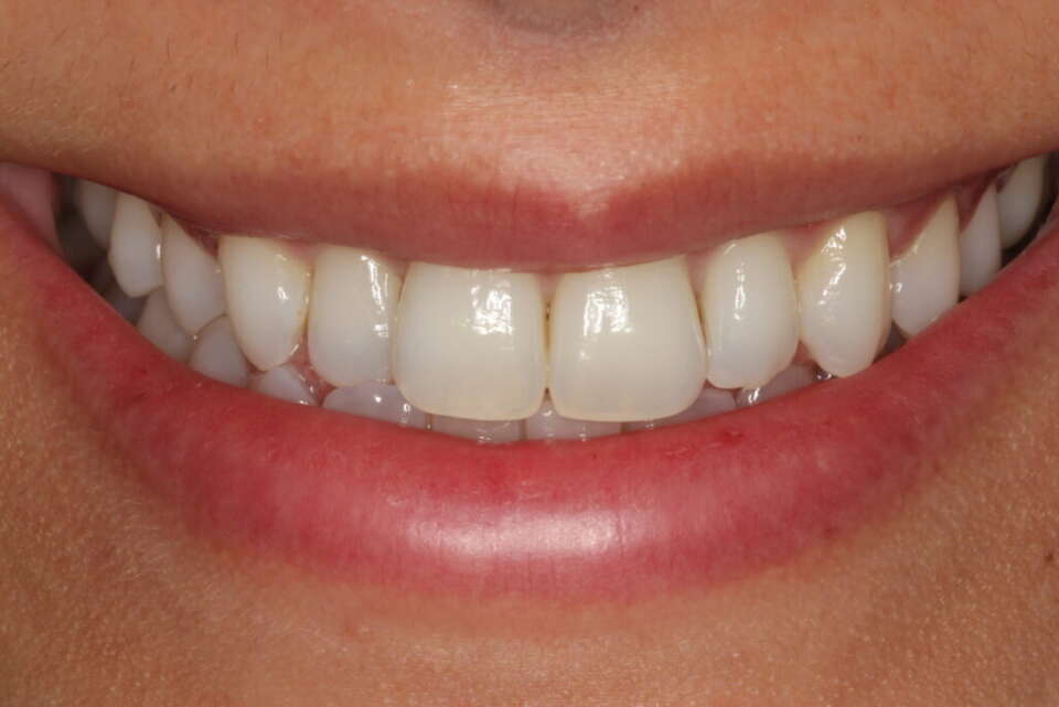 Social 6 teeth whitening 1