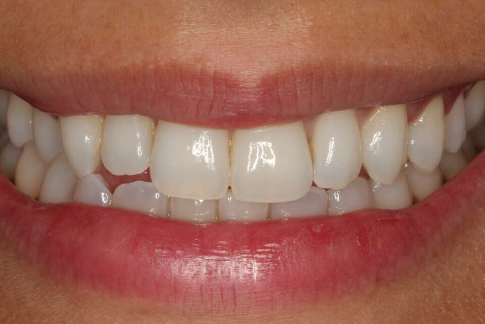 Social 6 teeth whitening 2