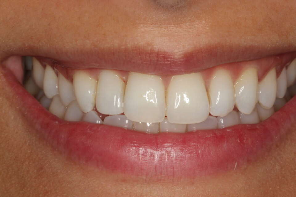 Social 6 teeth whitening 3