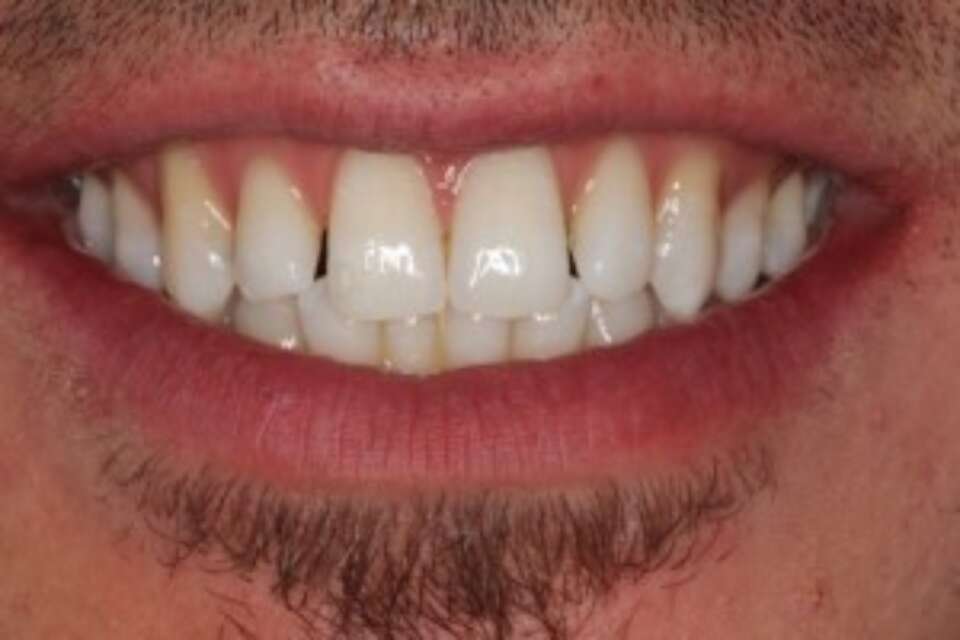 Spaces between front teeth